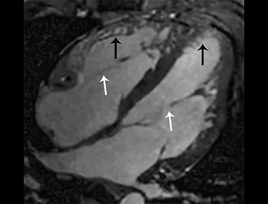 3cardiac_cine-4ch