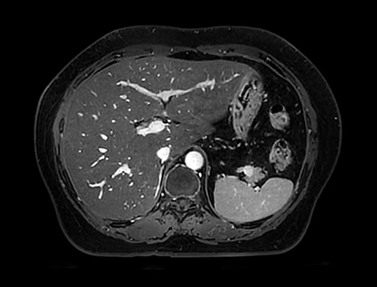 4ce-t1-abdomen