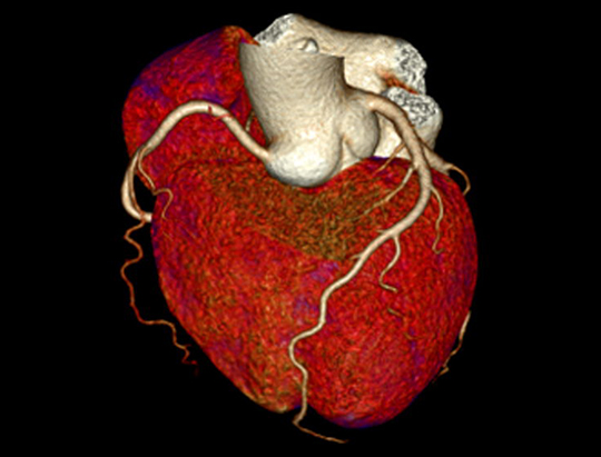 heart-bssfp-cine-1