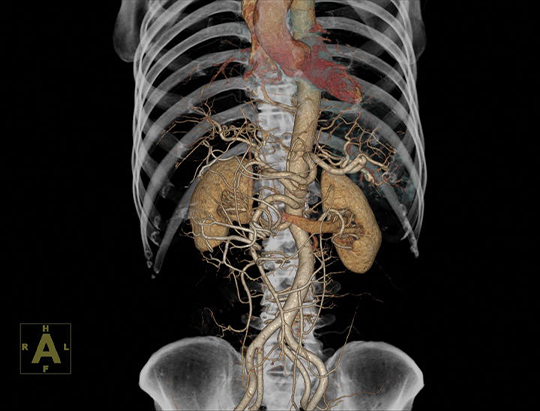vrt-of-abdomen